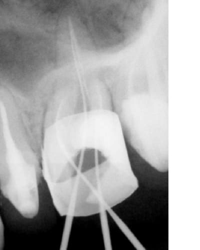 Endo jrpsvn - Eugenol