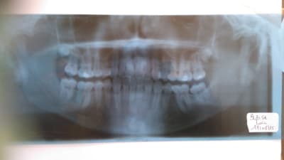 Dents h4ewyc - Eugenol