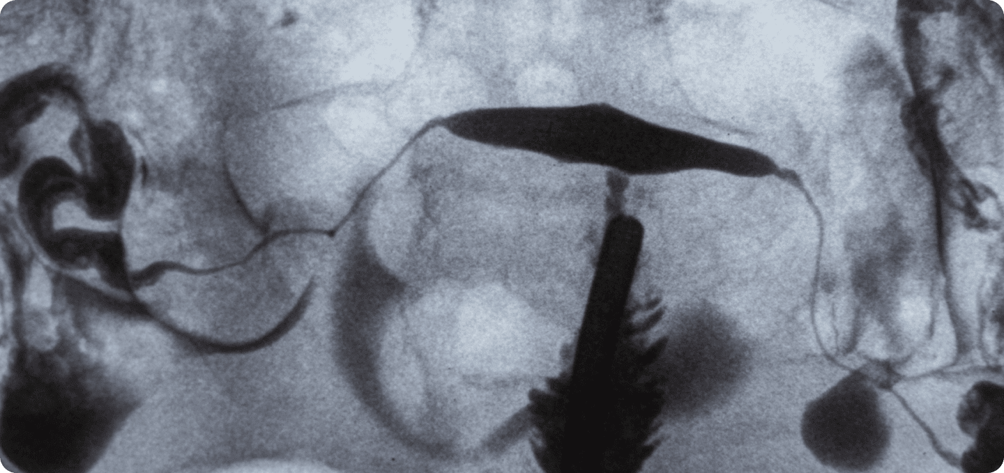 x-ray fallopian tubes