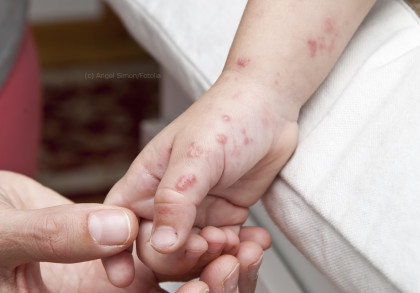 Nahaufnahme einer Kinderhand mit Windpocken-Ausschlag, die von einer erwachsenen Hand gehalten wird. Die Haut zeigt einige rote, geschwollene Blasen und Pusteln.
