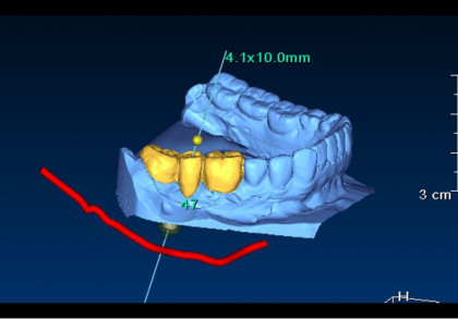 Ein digitales Modell eines menschlichen Ober- und Unterkiefers, wobei einige Zähne gelb hervorgehoben sind. Eine grüne Markierung zeigt die Abmessungen 4,1 x 10,0 mm an, und eine rote Linie verläuft unterhalb des Unterkiefers.