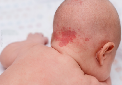Nahaufnahme des Rückens eines nackten Babys, das mit einer großen rötlichen Flechte am Hinterkopf liegt.