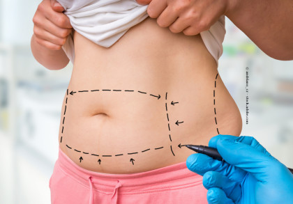 Eine Person zieht das Hemd hoch und enthüllt ihren Bauch, auf dem mit schwarzem Marker gestrichelte Linien und Pfeile gezeichnet sind. Eine behandschuhte Hand hält einen Marker und macht die Zeichnungen auf der Haut. Die Person trägt eine rosa Hose.