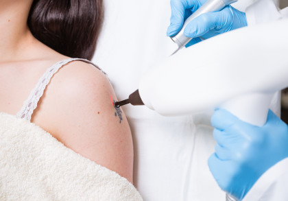 Tattooentfernung mit Laser auf der Schulter einer Frau. Eine Ärztin oder ein Arzt führt eine Laserbehandlung zur Tattooentfernung durch, die gezielt auf ein kleines Tattoo zielt. Die Frau trägt ein weißes Trägerhemd.