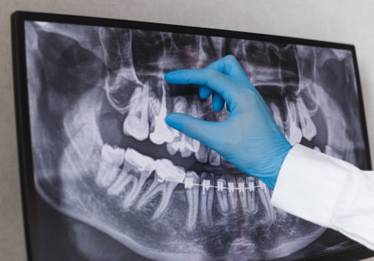 Ein Zahnarzt zeigt mit einer behandschuhten Hand auf ein Zahn-Röntgenbild auf einem Bildschirm. Das Bild zeigt detailliert die Zahnstruktur und kieferorthopädische Elemente.