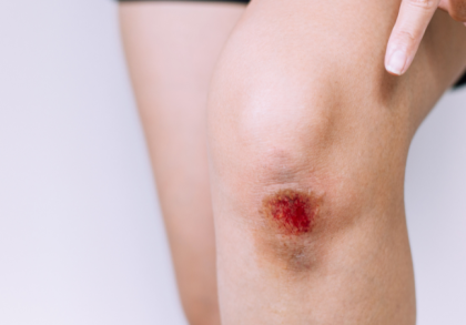 Offene Schürfwunde am Knie mit sichtbarer Rötung und Blutung, eine Person zeigt mit dem Finger darauf – typisches Beispiel für eine oberflächliche Verletzung, die eine sorgfältige Wundreinigung und Versorgung erfordert.