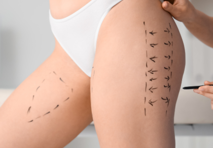 Ärztin markiert Behandlungsbereiche an Hüfte und Oberschenkel vor einer Liposuktion zur gezielten Entfernung hartnäckiger Fettdepots.