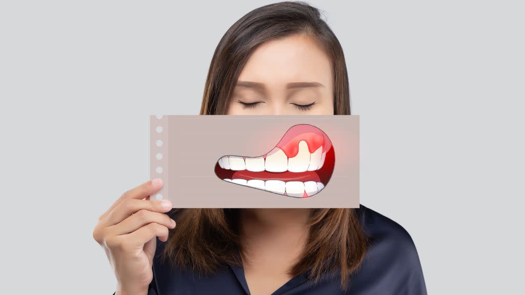 Die Zahnfleischentzündung oder Gingivitis ist eine Entzündung des Zahnfleisches, die ohne Behandlung massive gesundheitliche Folgen für die Zähne haben kann.