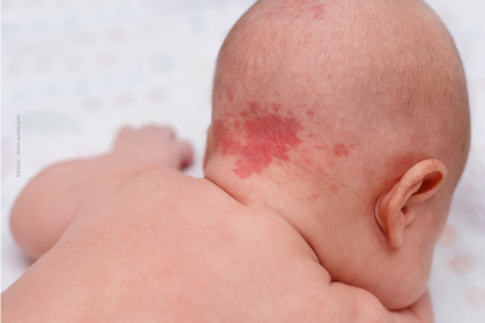 Nahaufnahme des Rückens eines nackten Babys, das mit einer großen rötlichen Flechte am Hinterkopf liegt.