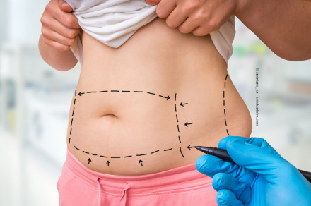Eine Person zieht das Hemd hoch und enthüllt ihren Bauch, auf dem mit schwarzem Marker gestrichelte Linien und Pfeile gezeichnet sind. Eine behandschuhte Hand hält einen Marker und macht die Zeichnungen auf der Haut. Die Person trägt eine rosa Hose.