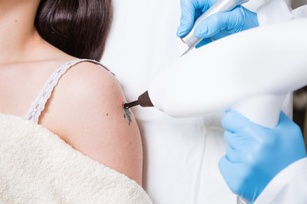 Tattooentfernung mit Laser auf der Schulter einer Frau. Eine Ärztin oder ein Arzt führt eine Laserbehandlung zur Tattooentfernung durch, die gezielt auf ein kleines Tattoo zielt. Die Frau trägt ein weißes Trägerhemd.
