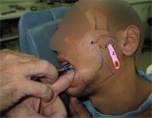 051014 anesth invdmu - Eugenol