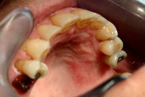 11 cicat palais a 15j layt3l - Eugenol