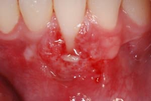 12 jours post op yq86sa - Eugenol