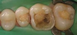 2 q1 amalgames enlev s medium  qbcrni - Eugenol