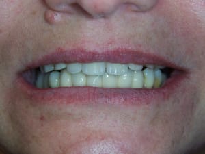 2010 mcipe positdental 196 ddp6ig - Eugenol