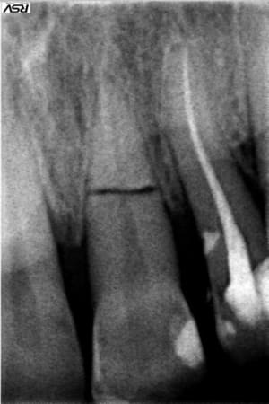 22 endo   fracture 21 hzwqc7 - Eugenol