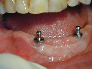 Aa la greffe et les boules isgh9y - Eugenol