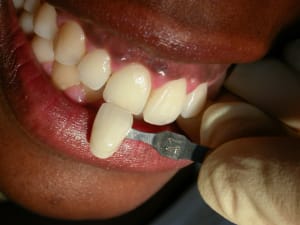 Après2appli g6ngks - Eugenol