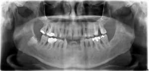 Bridge colle ant rbcbkt - Eugenol