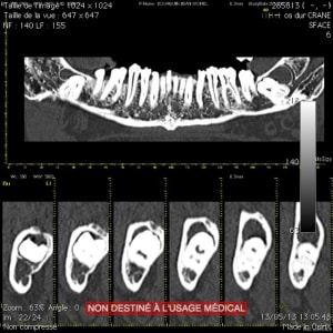 Ct2 svflfu - Eugenol