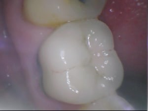 Cam buccale pa5nzf - Eugenol