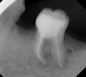 Canal courbe ubbom0 - Eugenol