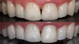 Centrale unitaire zircone translucide ht ceramique feldspathique noritake chappe anatomique transparence mimetisme - Eugenol