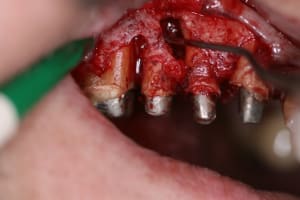 D bridement2 el1f4p - Eugenol