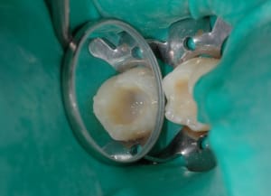 Dentine1 k4lrci - Eugenol