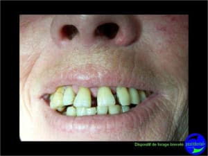 Eimci et canine incluse positdental 06 wdwwrl - Eugenol