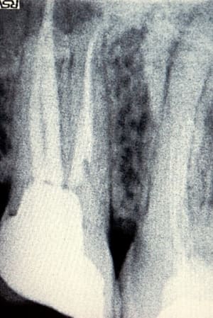 Endo17 ecmban - Eugenol