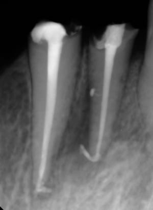 Endo bien jojvxu - Eugenol
