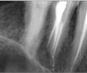 Endo 23  3   3rd canal postop ke3mkd - Eugenol