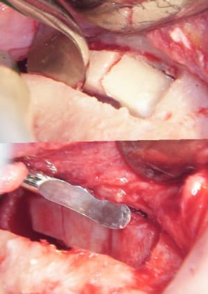 Expansion osseuse et sinus lift 2 jbxc7o - Eugenol