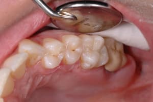Fini ormchu - Eugenol