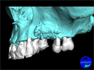 Guide chirurgical 002 vtt1yt - Eugenol