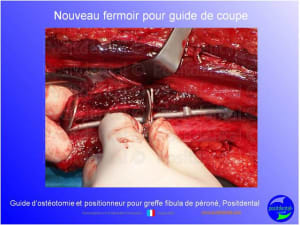 Guide d ost otomie  positionneur fibula positdental004 fsx7cv - Eugenol