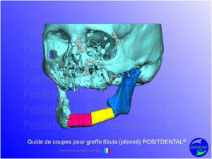Guide de coupes pour greffe fibula  p ron   positdental 010 drlxie - Eugenol