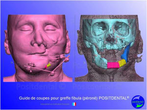 Guide de coupes pour greffe fibula  p ron   positdental 012 m0spye - Eugenol