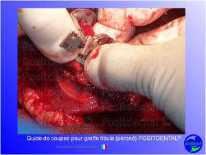 Guide de coupes pour greffe fibula  p ron   positdental 020 ardeku - Eugenol