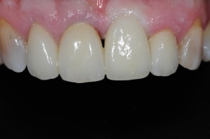 Guillaumin j 5 mois  pose ccm d finitive rey09b - Eugenol