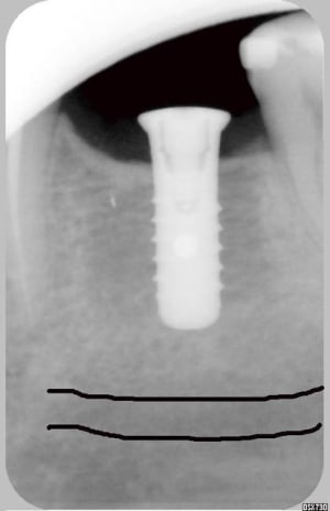 Implant1 phvodv - Eugenol