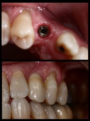 Implants1 ot2owh - Eugenol