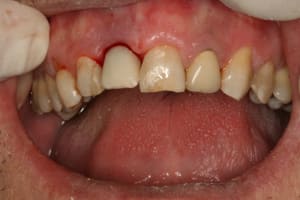 Implant 11 008 ke7wua - Eugenol