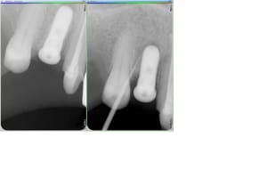 Implant 14 p7jtjv - Eugenol