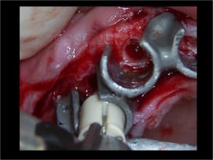 Implant astra et mci 003 ad2wwv - Eugenol