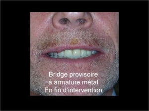 Implant dentsply ankylos et mci 003 stl6yw - Eugenol