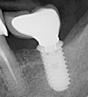 Implant md urznri - Eugenol
