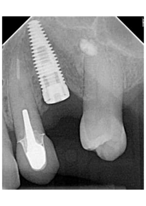 Implant  ptowhs - Eugenol